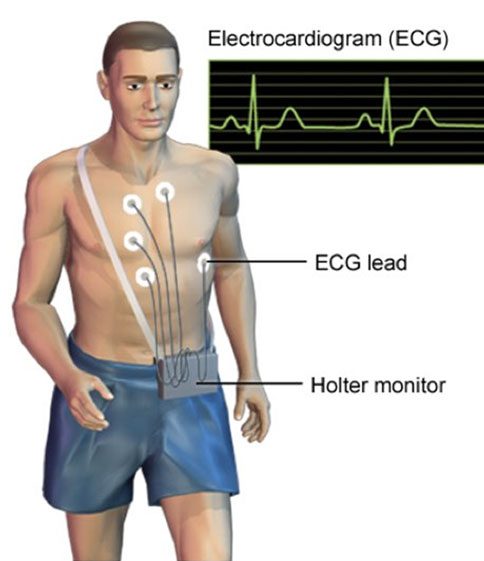 câble de holter d'ecg